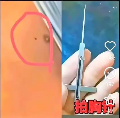 能让人瞬间死亡的-拍胸针-器官移植-新蔡学生